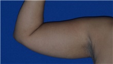 Liposuction Before Photo by Karol Gutowski, MD, FACS; Glenview, IL - Case 40555