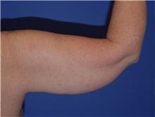 Liposuction Before Photo by Karol Gutowski, MD, FACS; Glenview, IL - Case 40556