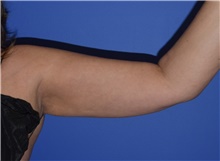 Liposuction After Photo by Karol Gutowski, MD, FACS; Glenview, IL - Case 40557