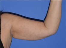 Liposuction Before Photo by Karol Gutowski, MD, FACS; Glenview, IL - Case 40557
