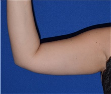 Liposuction Before Photo by Karol Gutowski, MD, FACS; Glenview, IL - Case 40558
