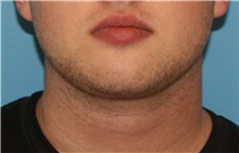 Liposuction After Photo by Karol Gutowski, MD, FACS; Glenview, IL - Case 40561