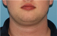 Liposuction Before Photo by Karol Gutowski, MD, FACS; Glenview, IL - Case 40561