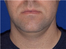 Liposuction Before Photo by Karol Gutowski, MD, FACS; Glenview, IL - Case 40562