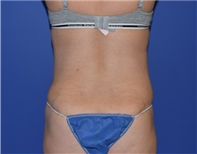 Liposuction After Photo by Karol Gutowski, MD, FACS; Glenview, IL - Case 40566
