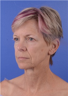 Facelift Before Photo by Glynn Bolitho, MD, PhD, FACS; La Jolla, CA - Case 48093