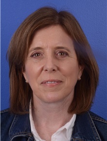 Facelift After Photo by Glynn Bolitho, MD, PhD, FACS; La Jolla, CA - Case 48095