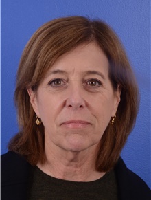 Facelift Before Photo by Glynn Bolitho, MD, PhD, FACS; La Jolla, CA - Case 48095