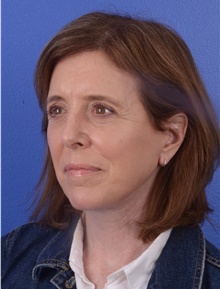 Facelift After Photo by Glynn Bolitho, MD, PhD, FACS; La Jolla, CA - Case 48095