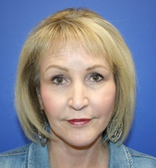 Facelift After Photo by Glynn Bolitho, MD, PhD, FACS; ,  - Case 48112