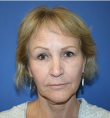 Facelift Before Photo by Glynn Bolitho, MD, PhD, FACS; ,  - Case 48112
