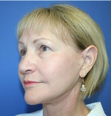 Facelift After Photo by Glynn Bolitho, MD, PhD, FACS; ,  - Case 48112