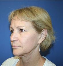 Facelift Before Photo by Glynn Bolitho, MD, PhD, FACS; ,  - Case 48112