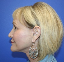 Facelift After Photo by Glynn Bolitho, MD, PhD, FACS; ,  - Case 48112