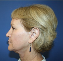 Facelift Before Photo by Glynn Bolitho, MD, PhD, FACS; ,  - Case 48112