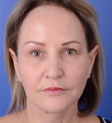 Facelift After Photo by Glynn Bolitho, MD, PhD, FACS; ,  - Case 48112