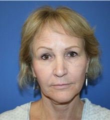 Facelift Before Photo by Glynn Bolitho, MD, PhD, FACS; ,  - Case 48112