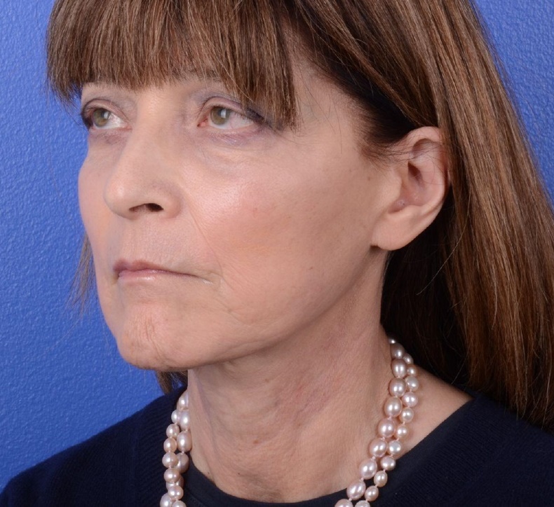 Facelift Before and After Photos by Glynn Bolitho, MD, PhD, FACS; La