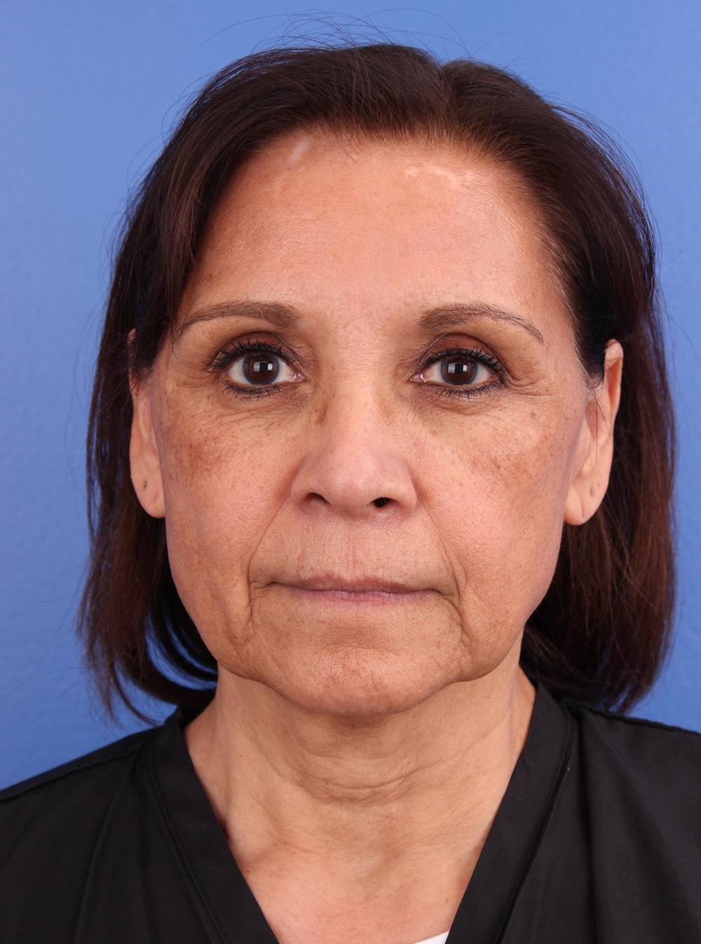 Facelift Before and After Photos by Glynn Bolitho, MD, PhD, FACS; La