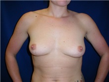 Breast Augmentation Before Photo by Thomas McNemar, MD; Tracy, CA - Case 7807