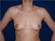 Breast Augmentation Before Photo by Thomas McNemar, MD; Tracy, CA - Case 7808