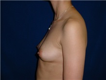 Breast Augmentation Before Photo by Thomas McNemar, MD; Tracy, CA - Case 7808