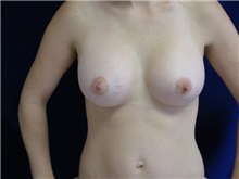 Breast Augmentation After Photo by Thomas McNemar, MD; Tracy, CA - Case 7809