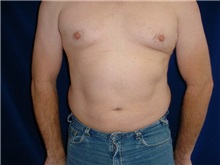 Liposuction After Photo by Thomas McNemar, MD; Tracy, CA - Case 7812