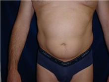 Liposuction Before Photo by Thomas McNemar, MD; Tracy, CA - Case 7812