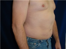 Liposuction After Photo by Thomas McNemar, MD; Tracy, CA - Case 7812