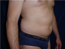 Liposuction Before Photo by Thomas McNemar, MD; Tracy, CA - Case 7812