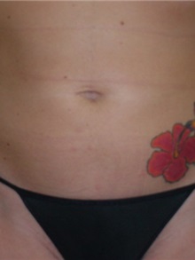 Liposuction After Photo by Thomas McNemar, MD; Tracy, CA - Case 7813