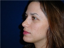 Rhinoplasty After Photo by Thomas McNemar, MD; Tracy, CA - Case 7817