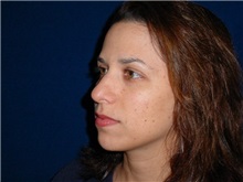 Rhinoplasty Before Photo by Thomas McNemar, MD; Tracy, CA - Case 7817