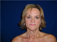 Facelift Before Photo by Thomas McNemar, MD; Tracy, CA - Case 7823