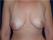 Breast Augmentation Before Photo by Thomas McNemar, MD; Tracy, CA - Case 8748