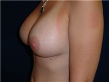 Breast Augmentation After Photo by Thomas McNemar, MD; Tracy, CA - Case 8748