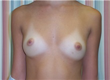 Breast Augmentation Before Photo by Stanley Castor, MD; Tampa, FL - Case 39248
