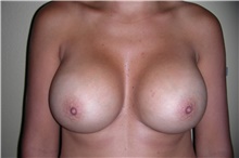 Breast Augmentation After Photo by Stanley Castor, MD; Tampa, FL - Case 39249