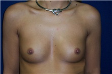 Breast Augmentation Before Photo by Stanley Castor, MD; Tampa, FL - Case 39249