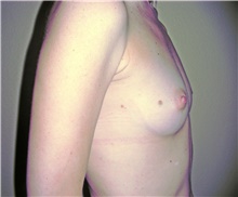 Breast Augmentation Before Photo by Stanley Castor, MD; Tampa, FL - Case 39251