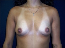 Breast Augmentation Before Photo by Stanley Castor, MD; Tampa, FL - Case 39259