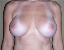 Breast Augmentation After Photo by Stanley Castor, MD; Tampa, FL - Case 39260