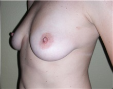 Breast Augmentation Before Photo by Stanley Castor, MD; Tampa, FL - Case 39260