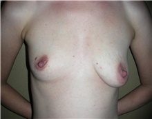 Breast Augmentation Before Photo by Stanley Castor, MD; Tampa, FL - Case 39262