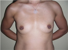Breast Augmentation Before Photo by Stanley Castor, MD; Tampa, FL - Case 39263