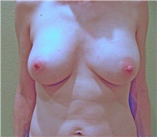 Breast Augmentation After Photo by Stanley Castor, MD; Tampa, FL - Case 39264