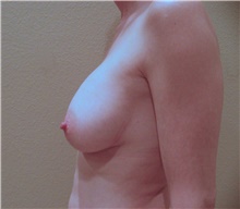 Breast Augmentation After Photo by Stanley Castor, MD; Tampa, FL - Case 39264