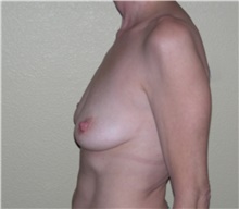 Breast Augmentation Before Photo by Stanley Castor, MD; Tampa, FL - Case 39264