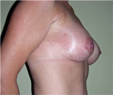 Breast Augmentation After Photo by Stanley Castor, MD; Tampa, FL - Case 39265
